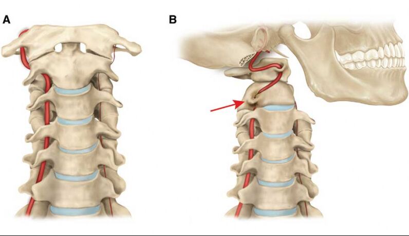 Curso da artéria vertebral