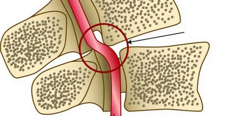 Deformação da artéria vertebral devido à instabilidade vertebral